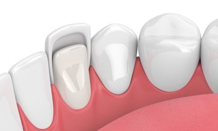 3d render of teeth with veneer over white