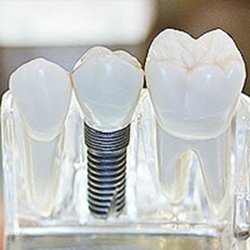 dental-implants-small