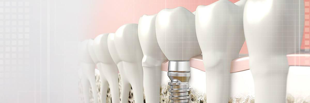 dental-implants